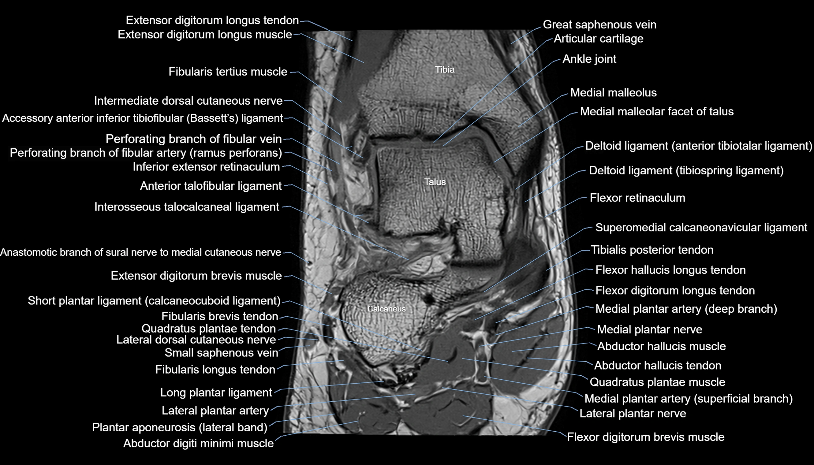Ankle coronal anatomy 3T MRI images -img-11001-00008.webp